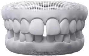 Diastema